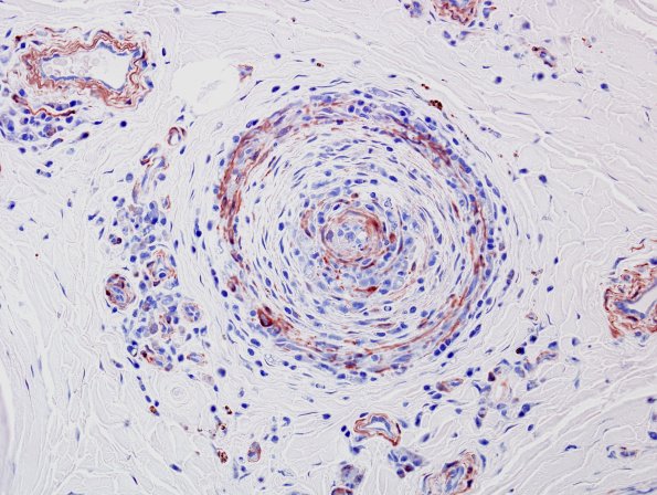 27B2 Vasculitis (Case 27) SMA 2