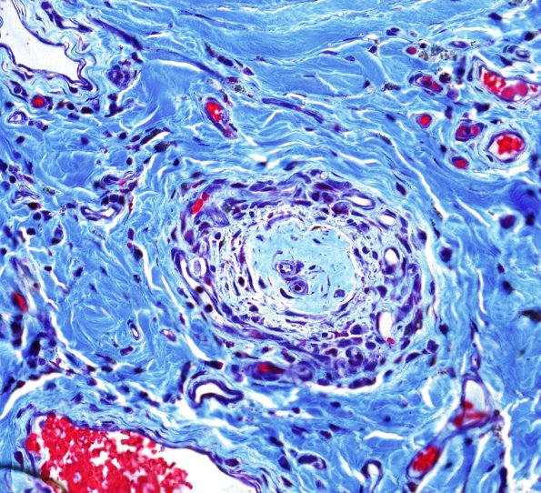 27C1 Vasculitis (Case 27) Trichrome 1