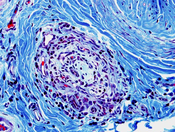 27C2 Vasculitis (Case 27) Trichrome 3