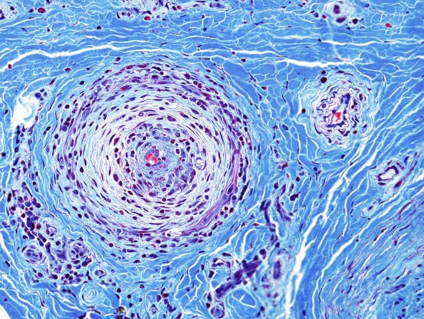 27C3 Vasculitis (Case 27) Trichrome 2