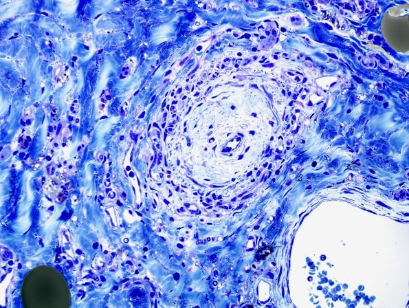 27D1 Vasculitis (Case 27) Plastic 1