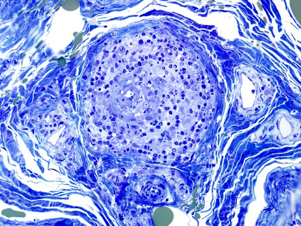 27D2 Vasculitis (Case 27) Plastic 2