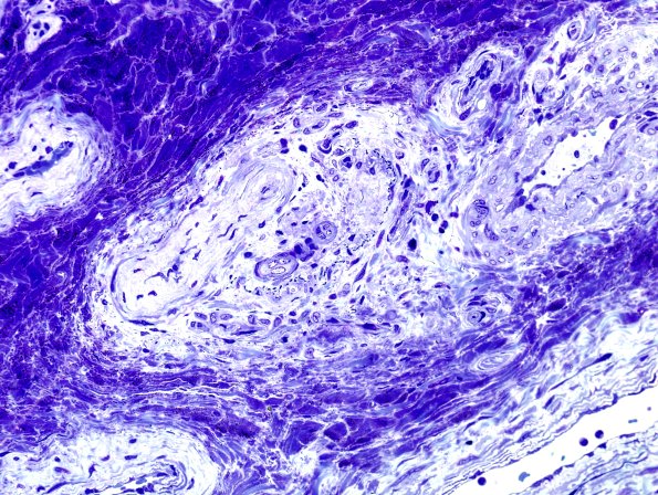 28C Vasculitis (Case 28) Plastic 2