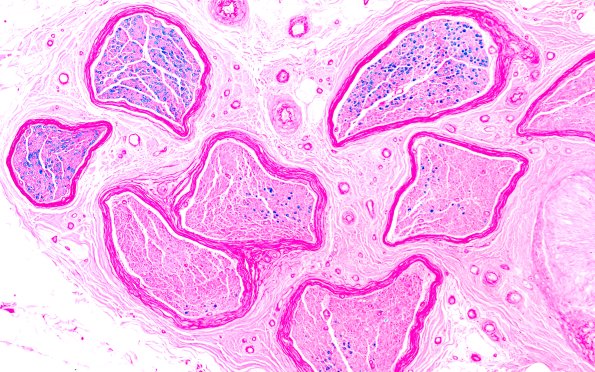 2B1 (Case 2) LFB 10X 2