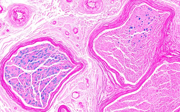 2B2 (Case 2) LFB 20X 1