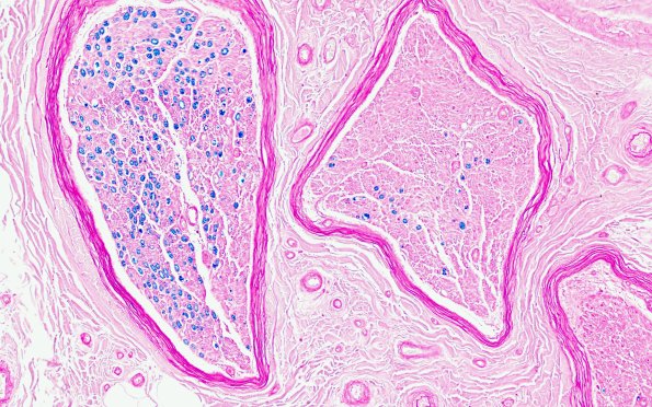 2B3 (Case 2) LFB 20X 2