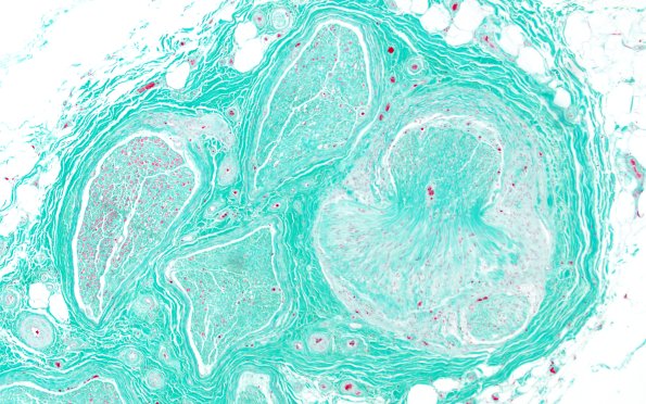 2C1 (Case 2) TRI 10X 1