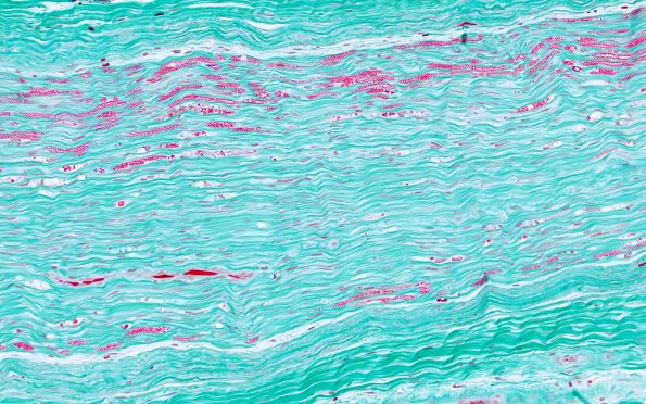 2C2 (Case 2) TRI 10X 2