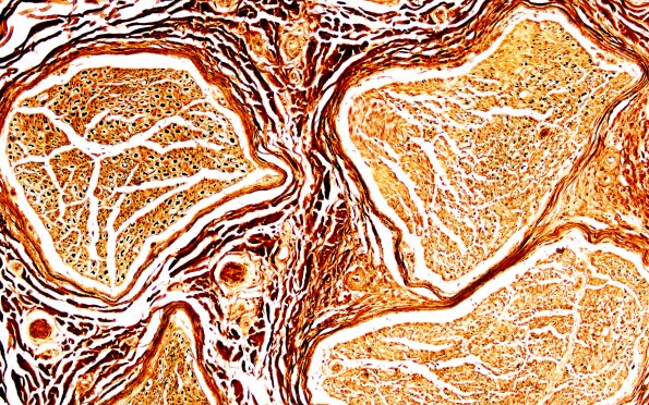 2D1 (Case 2) Biels 20X 2A