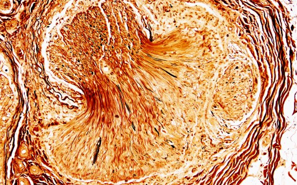 2D2 (Case 2) Biels 20X 3