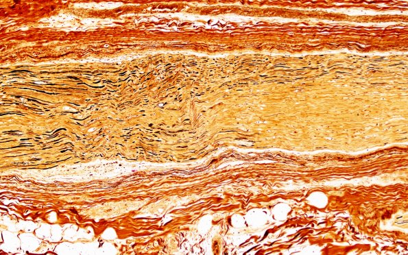 2D3 (Case 2) Biels 10X 1