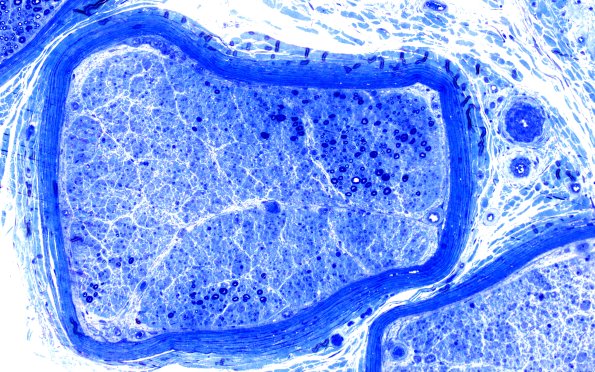 2E5 (Case 2) Block B1 20X