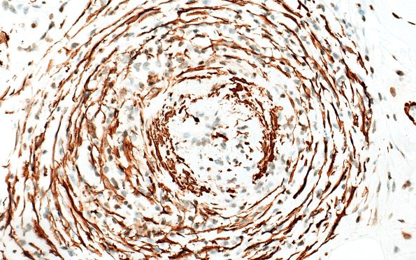 31B4 Vasculitis (Case 31) SMA 40X