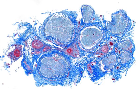 31F1 Vasculitis (Case 31) TRI 2X