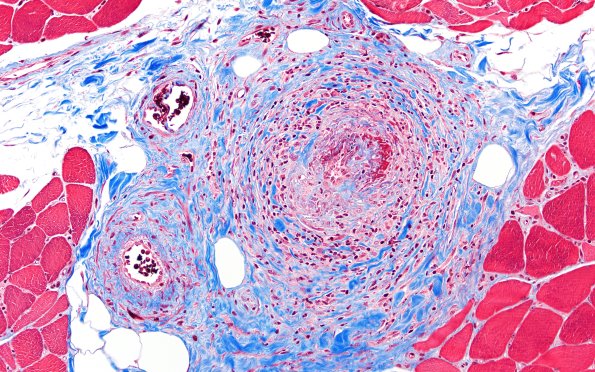 31F3 Vasculitis (Case 31) TRI 20X
