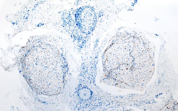 31G Vasculitis (Case 31) NF 10X
