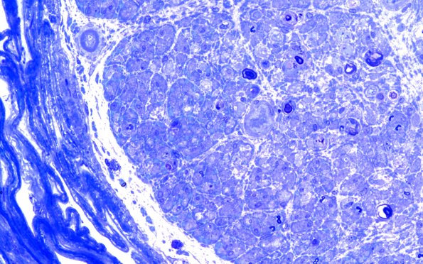 31H1C Vasculitis (Case 31) Plastic 60X