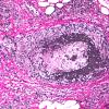 3B Vasculitis NOS (Case 3) VVG 20X