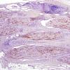 4B1-Vasculitis-Case-4B-NF-2.jpg