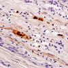 4B6-Vasculitis-Case-4B-NF-12.jpg