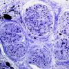 4C1-Vasculitis-Case-4C-Plastic-5.jpg