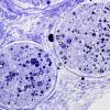 4C2-Vasculitis-Case-4C-Plastic-6.jpg