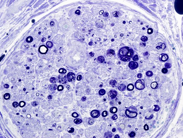 4C3-Vasculitis-Case-4C-Plastic-1.jpg