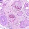 5A2 Vasculitis (Case 5) H&E 1