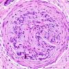 5A3 Vasculitis (Case 5) H&E 4