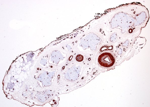 5B1 Vasculitis (Case 5) SMA 1