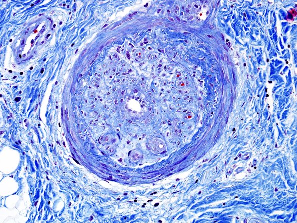 5D1 Vasculitis (Case 5) Trichrome 1