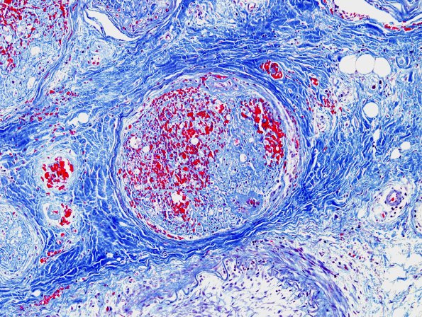5D2 Vasculitis (Case 5) Trichrome 2