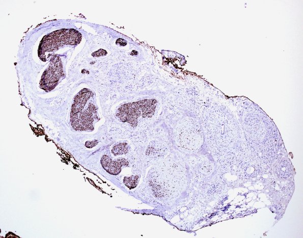5E1 Vasculitis (Case 5) NF 7
