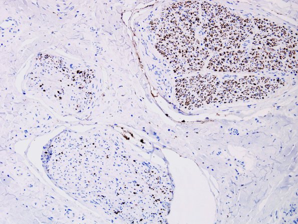 5E3 Vasculitis (Case 5) NF 3