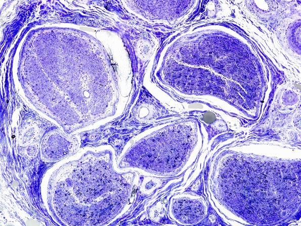 5F1 Vasculitis (Case 5) Plastic 4