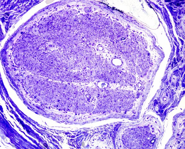 5F2 Vasculitis (Case 5) Plastic 3