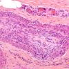 9A2-Vasculitis-Case-9A7-1.jpg