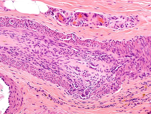 9A2-Vasculitis-Case-9A7-1.jpg