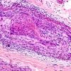9A3-Vasculitis-Case-9A-4.jpg