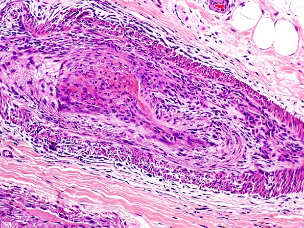 9A3-Vasculitis-Case-9A-4.jpg