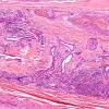 9D-Vasculitis-Case-9D-Plastic-3.jpg