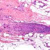 9E-Vasculitis-Case-9E-H-E-2.jpg