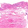 1A1 Vasculitis Churg-Strauss (Case 1) FDS n D H&E 1