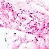 1A3 Vasculitis Churg-Strauss (Case 1) AIN n C H&E 40X