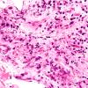 1A5 Vasculitis Churg-Strauss (Case 1) FDS n D1 H&E 60X 3