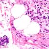 1A7 Vasculitis Churg-Strauss (Case 1) FDS n D1 H&E 60X