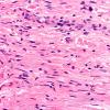 1A9 Vasculitis Churg-Strauss (Case 1) AIN n C1 H&E 40X 2