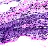 1B2 Vasculitis Churg-Strauss (Case 1) D1 Elastin 40X copy