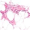 4A12 Vasculitis, Churg-Strauss (Case 4) H&E 40X 8