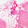 4A2 Vasculitis, Churg-Strauss (Case 4) H&E 10X 2